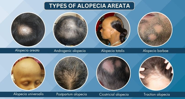 Crown Care Alopecia System